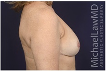 Breast Reduction After Photo by Michael Law, MD; Raleigh, NC - Case 42216