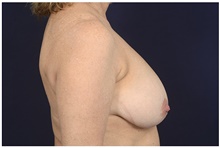 Breast Reduction Before Photo by Michael Law, MD; Raleigh, NC - Case 42216