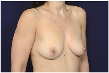 Breast Augmentation Before Photo by Michael Law, MD; Raleigh, NC - Case 42220