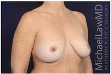 Breast Reduction After Photo by Michael Law, MD; Raleigh, NC - Case 42225