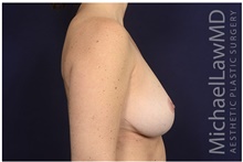 Breast Reduction After Photo by Michael Law, MD; Raleigh, NC - Case 42225