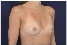 Breast Augmentation Before Photo by Michael Law, MD; Raleigh, NC - Case 42238