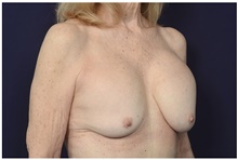 Breast Implant Revision Before Photo by Michael Law, MD; Raleigh, NC - Case 42351