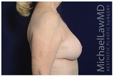 Breast Implant Revision After Photo by Michael Law, MD; Raleigh, NC - Case 42351