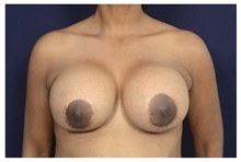 Breast Implant Revision Before Photo by Michael Law, MD; Raleigh, NC - Case 42352