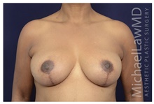 Breast Implant Revision After Photo by Michael Law, MD; Raleigh, NC - Case 42352