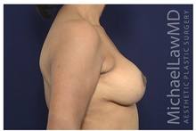 Breast Implant Revision After Photo by Michael Law, MD; Raleigh, NC - Case 42352
