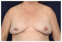 Breast Implant Revision Before Photo by Michael Law, MD; Raleigh, NC - Case 42353