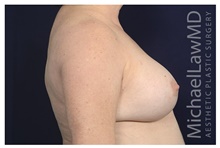 Breast Implant Revision After Photo by Michael Law, MD; Raleigh, NC - Case 42353