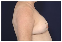 Breast Implant Revision Before Photo by Michael Law, MD; Raleigh, NC - Case 42353