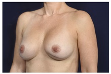 Breast Implant Revision Before Photo by Michael Law, MD; Raleigh, NC - Case 42354