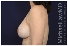Breast Implant Revision After Photo by Michael Law, MD; Raleigh, NC - Case 42354