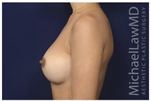 Breast Implant Revision After Photo by Michael Law, MD; Raleigh, NC - Case 42355