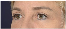 Eyelid Surgery After Photo by Michael Law, MD; Raleigh, NC - Case 42357