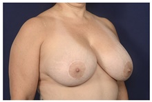 Breast Reduction Before Photo by Michael Law, MD; Raleigh, NC - Case 42359