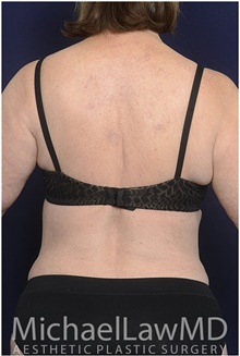 Body Contouring After Photo by Michael Law, MD; Raleigh, NC - Case 42361