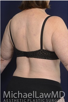 Body Contouring After Photo by Michael Law, MD; Raleigh, NC - Case 42361