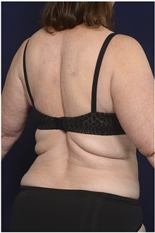 Body Contouring Before Photo by Michael Law, MD; Raleigh, NC - Case 42361