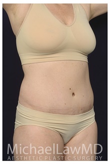 Liposuction After Photo by Michael Law, MD; Raleigh, NC - Case 42362