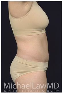 Liposuction After Photo by Michael Law, MD; Raleigh, NC - Case 42362