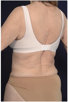 Body Contouring Before Photo by Michael Law, MD; Raleigh, NC - Case 42363