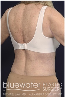 Body Contouring After Photo by Michael Law, MD; Raleigh, NC - Case 42363