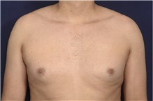 Male Breast Reduction Before Photo by Michael Law, MD; Raleigh, NC - Case 44468