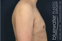 Male Breast Reduction After Photo by Michael Law, MD; Raleigh, NC - Case 44468