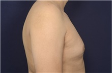Male Breast Reduction Before Photo by Michael Law, MD; Raleigh, NC - Case 44468
