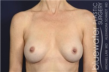 Breast Implant Revision After Photo by Michael Law, MD; Raleigh, NC - Case 44469
