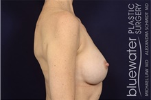 Breast Implant Revision After Photo by Michael Law, MD; Raleigh, NC - Case 44469
