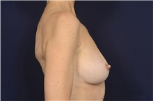 Breast Implant Revision Before Photo by Michael Law, MD; Raleigh, NC - Case 44469