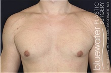 Male Breast Reduction After Photo by Michael Law, MD; Raleigh, NC - Case 44470