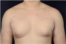 Male Breast Reduction Before Photo by Michael Law, MD; Raleigh, NC - Case 44470