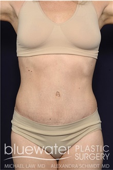 Tummy Tuck After Photo by Michael Law, MD; Raleigh, NC - Case 44471