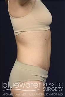 Tummy Tuck After Photo by Michael Law, MD; Raleigh, NC - Case 44471