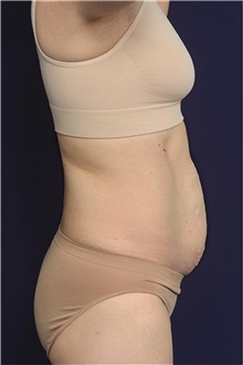 Tummy Tuck Before Photo by Michael Law, MD; Raleigh, NC - Case 44471