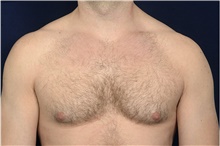 Male Breast Reduction Before Photo by Michael Law, MD; Raleigh, NC - Case 44472