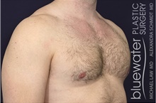 Male Breast Reduction After Photo by Michael Law, MD; Raleigh, NC - Case 44472