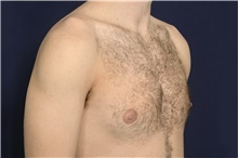Male Breast Reduction Before Photo by Michael Law, MD; Raleigh, NC - Case 44473
