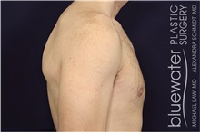 Male Breast Reduction After Photo by Michael Law, MD; Raleigh, NC - Case 44473
