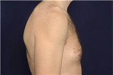 Male Breast Reduction Before Photo by Michael Law, MD; Raleigh, NC - Case 44473