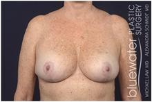 Breast Reduction After Photo by Michael Law, MD; Raleigh, NC - Case 44474