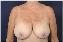 Breast Reduction Before Photo by Michael Law, MD; Raleigh, NC - Case 44474