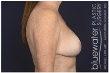 Breast Reduction After Photo by Michael Law, MD; Raleigh, NC - Case 44474