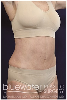 Tummy Tuck After Photo by Michael Law, MD; Raleigh, NC - Case 44477