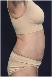 Tummy Tuck Before Photo by Michael Law, MD; Raleigh, NC - Case 44477