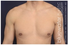 Male Breast Reduction After Photo by Michael Law, MD; Raleigh, NC - Case 44478