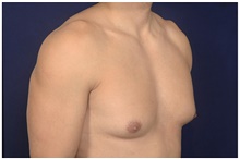 Male Breast Reduction Before Photo by Michael Law, MD; Raleigh, NC - Case 44478