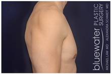 Male Breast Reduction After Photo by Michael Law, MD; Raleigh, NC - Case 44478